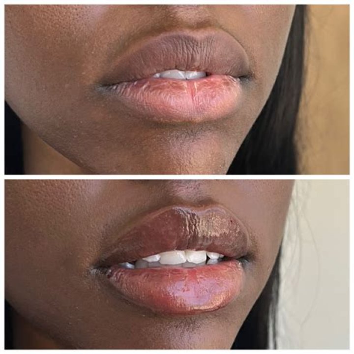 Does Suni Lee Have Lip Injections? Exploring the Truth Behind the Rumors