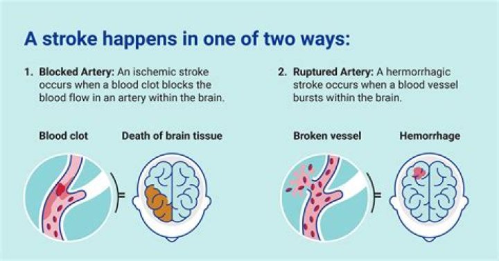 Pioneer Woman Stroke: Cause of Death Explained